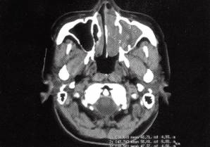 【病例】鼻腔鼻窦嗅神经母细胞瘤1例CT影像表现分析 【病例】鼻腔鼻窦嗅神经母细胞瘤1例CT影像表现分析