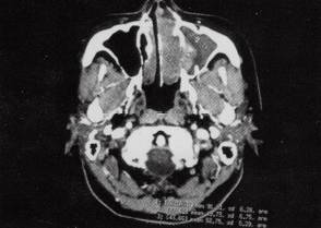 【病例】鼻腔鼻窦嗅神经母细胞瘤1例CT影像表现分析 【病例】鼻腔鼻窦嗅神经母细胞瘤1例CT影像表现分析