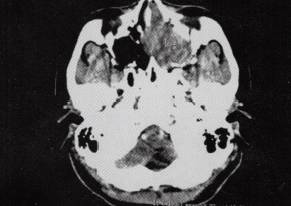 【病例】鼻腔鼻窦嗅神经母细胞瘤1例CT影像表现分析 【病例】鼻腔鼻窦嗅神经母细胞瘤1例CT影像表现分析