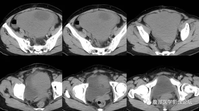 【病例】左侧卵巢间质肉瘤伴出血坏死囊变1例