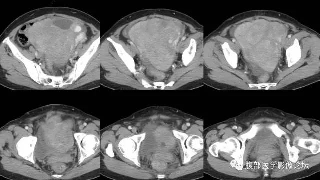 【病例】左侧卵巢间质肉瘤伴出血坏死囊变1例