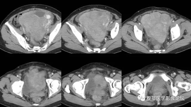 【病例】左侧卵巢间质肉瘤伴出血坏死囊变1例