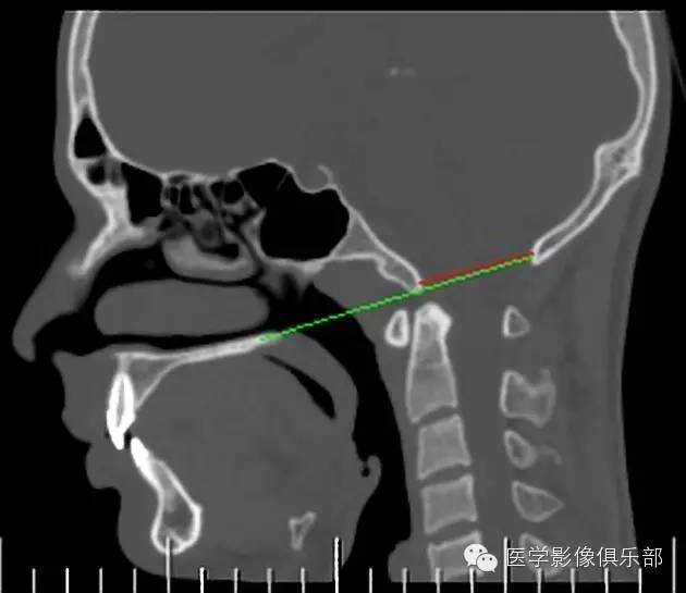 颅底凹陷症 basilar invagination 颅底凹陷症 basilar invagination