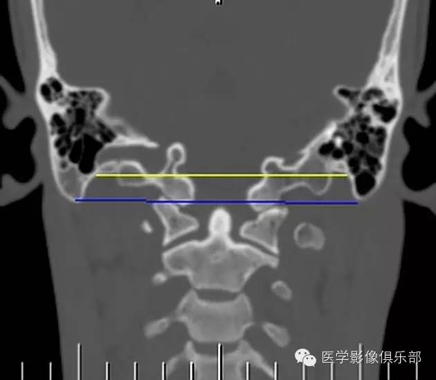 颅底凹陷症 basilar invagination 颅底凹陷症 basilar invagination