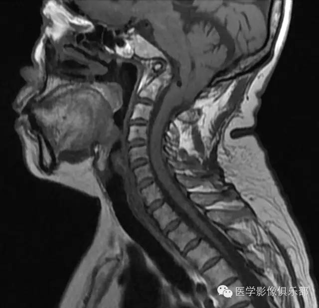 颅底凹陷症 basilar invagination 颅底凹陷症 basilar invagination