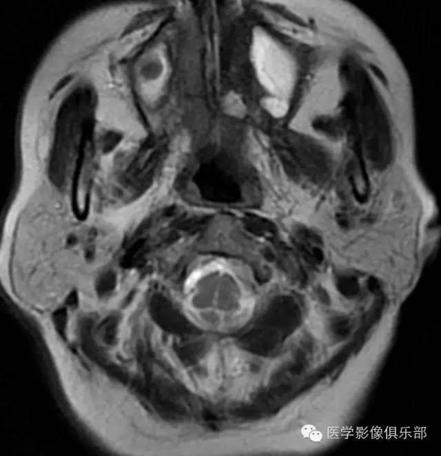 颅底凹陷症 basilar invagination 颅底凹陷症 basilar invagination