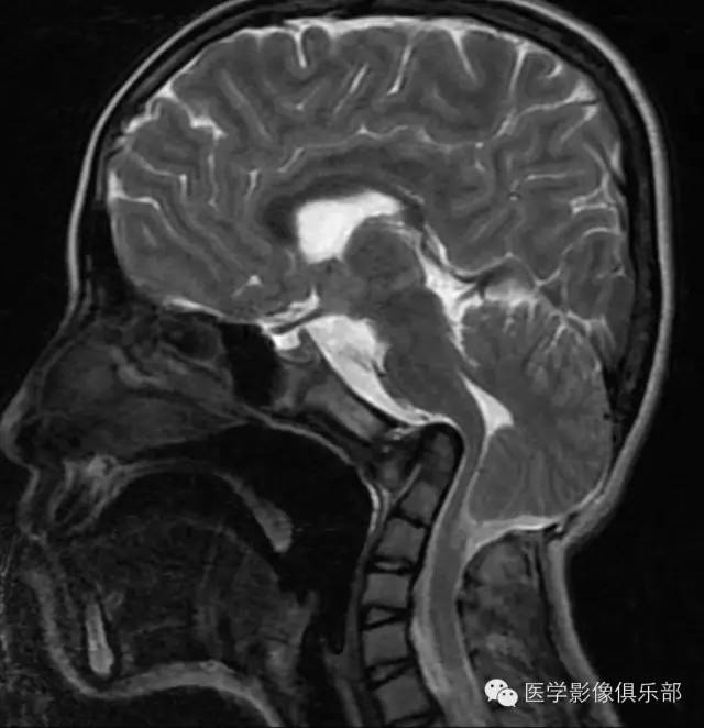 颅底凹陷症 basilar invagination 颅底凹陷症 basilar invagination