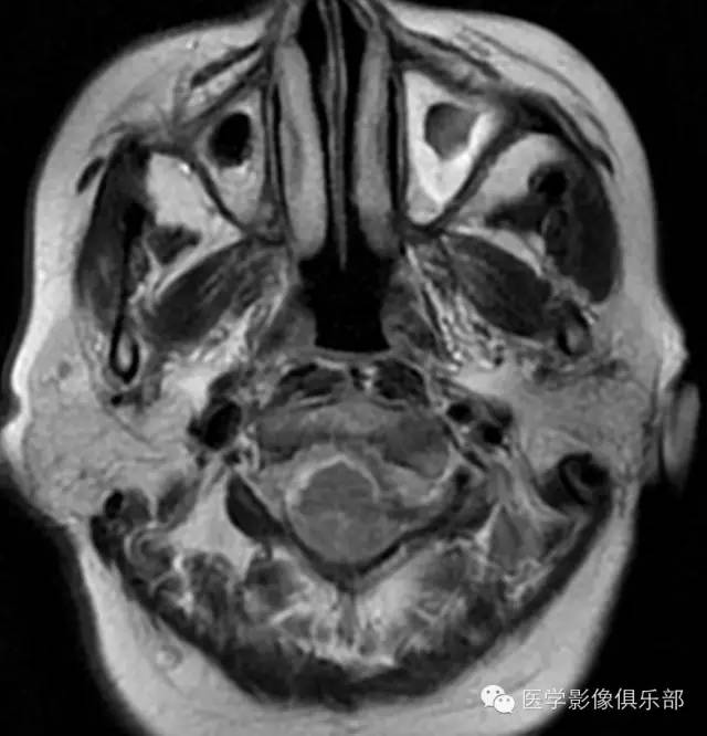 颅底凹陷症 basilar invagination 颅底凹陷症 basilar invagination