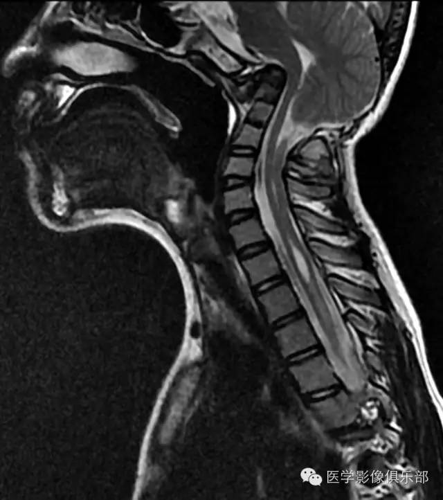 颅底凹陷症 basilar invagination 颅底凹陷症 basilar invagination