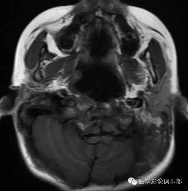 颅底凹陷症 basilar invagination 颅底凹陷症 basilar invagination