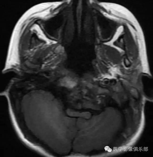 颅底凹陷症 basilar invagination 颅底凹陷症 basilar invagination