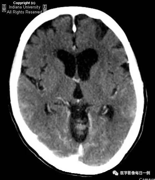 【病例】肺腺癌柔脑膜转移1例影像分析 【病例】肺腺癌柔脑膜转移1例影像分析