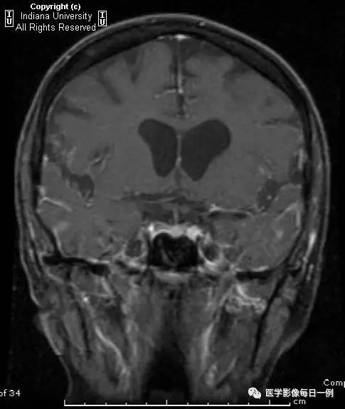 【病例】肺腺癌柔脑膜转移1例影像分析 【病例】肺腺癌柔脑膜转移1例影像分析