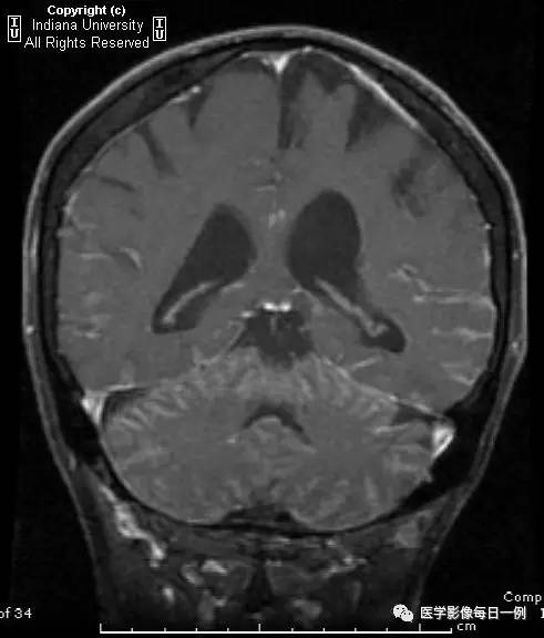 【病例】肺腺癌柔脑膜转移1例影像分析