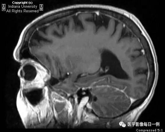【病例】肺腺癌柔脑膜转移1例影像分析 【病例】肺腺癌柔脑膜转移1例影像分析