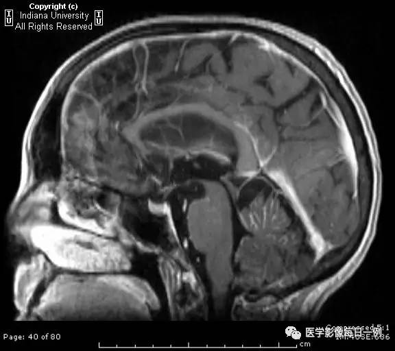 【病例】肺腺癌柔脑膜转移1例影像分析 【病例】肺腺癌柔脑膜转移1例影像分析