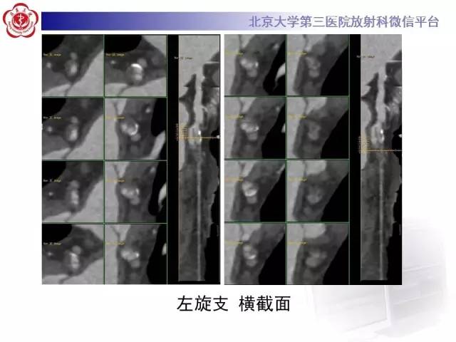 【病例】自发性冠状动脉夹层1例