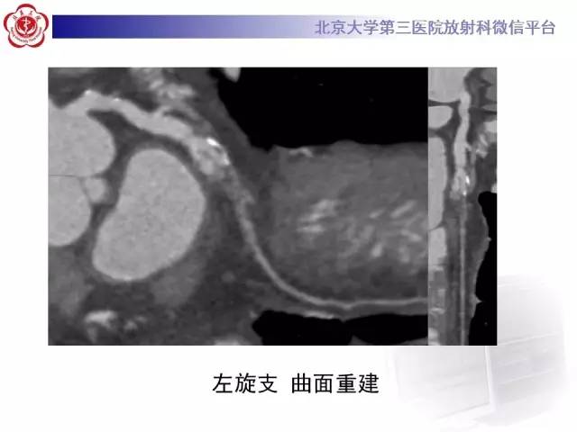 【病例】自发性冠状动脉夹层1例