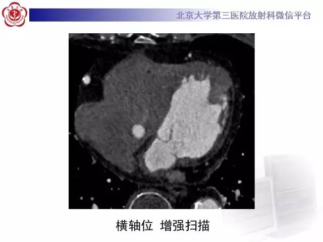 【病例】自发性冠状动脉夹层1例