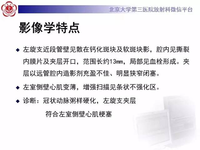 【病例】自发性冠状动脉夹层1例