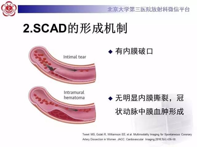 【病例】自发性冠状动脉夹层1例