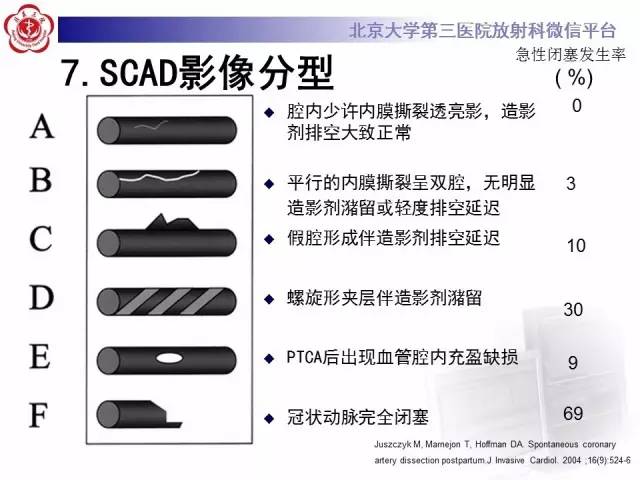 【病例】自发性冠状动脉夹层1例