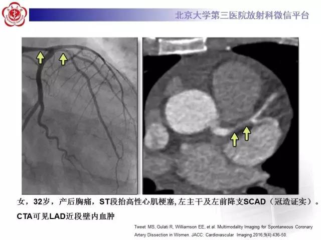 【病例】自发性冠状动脉夹层1例