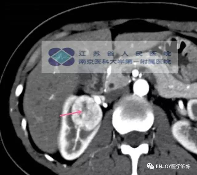 手把手教你会读片：肾嗜酸性细胞腺瘤