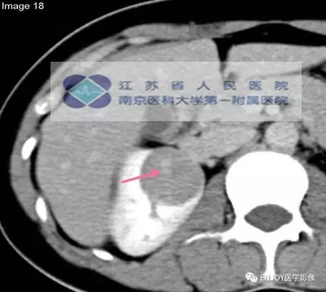 手把手教你会读片：肾嗜酸性细胞腺瘤