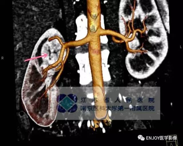 手把手教你会读片：肾嗜酸性细胞腺瘤