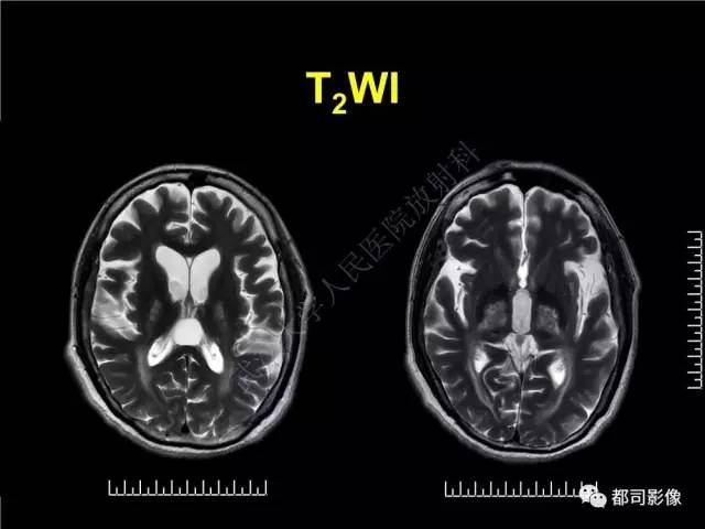 【PPT】脑腱黄瘤病影像诊断