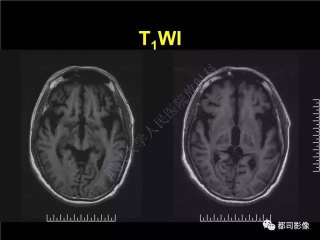 【PPT】脑腱黄瘤病影像诊断