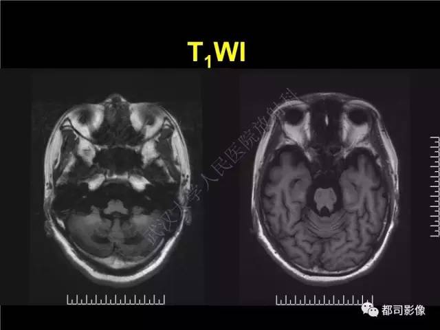 【PPT】脑腱黄瘤病影像诊断