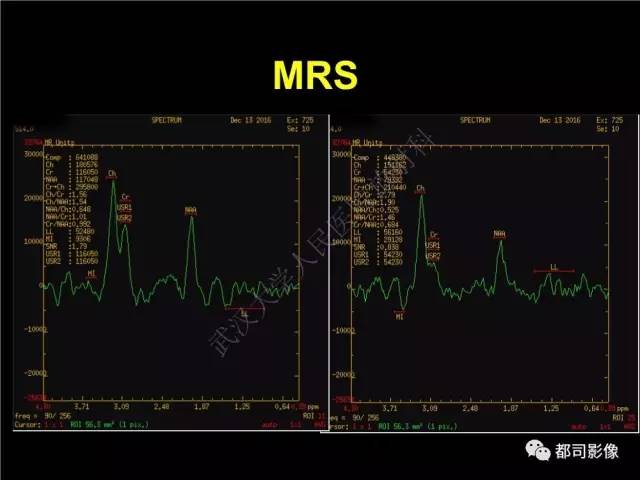 【PPT】脑腱黄瘤病影像诊断