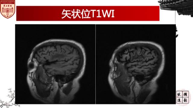 【病例】梅毒树胶样肿1例MR影像诊断与鉴别