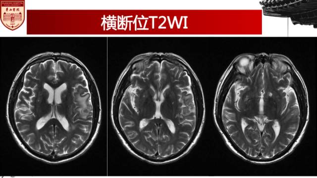 【病例】梅毒树胶样肿1例MR影像诊断与鉴别