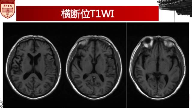 【病例】梅毒树胶样肿1例MR影像诊断与鉴别