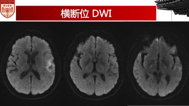 【病例】梅毒树胶样肿1例MR影像诊断与鉴别