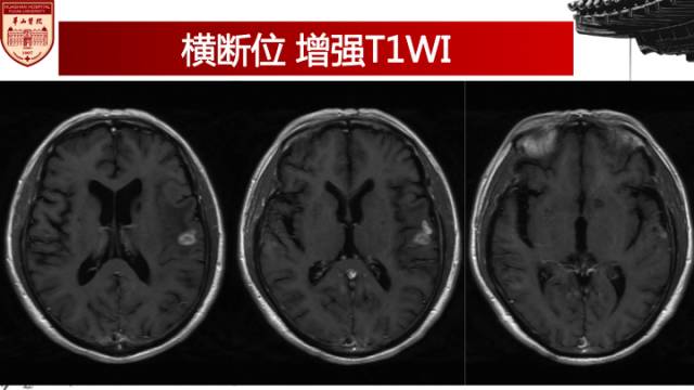 【病例】梅毒树胶样肿1例MR影像诊断与鉴别