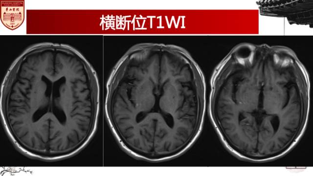 【病例】梅毒树胶样肿1例MR影像诊断与鉴别