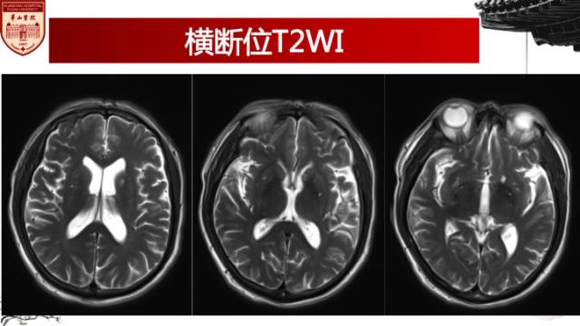 【病例】梅毒树胶样肿1例MR影像诊断与鉴别