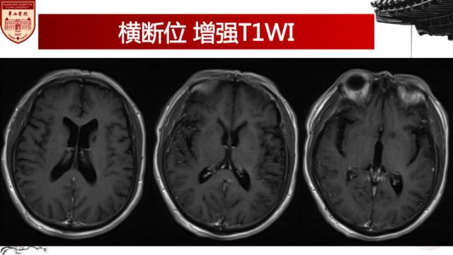 【病例】梅毒树胶样肿1例MR影像诊断与鉴别