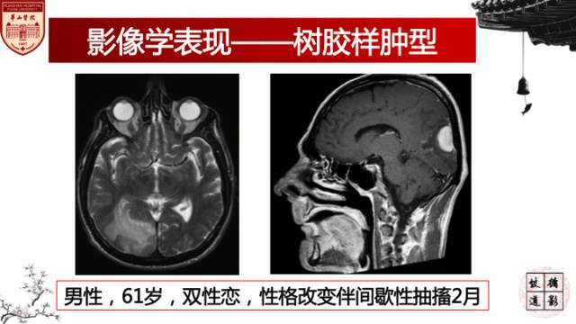 【病例】梅毒树胶样肿1例MR影像诊断与鉴别