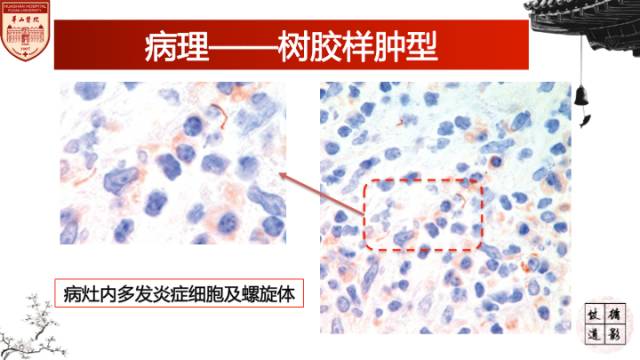 【病例】梅毒树胶样肿1例MR影像诊断与鉴别