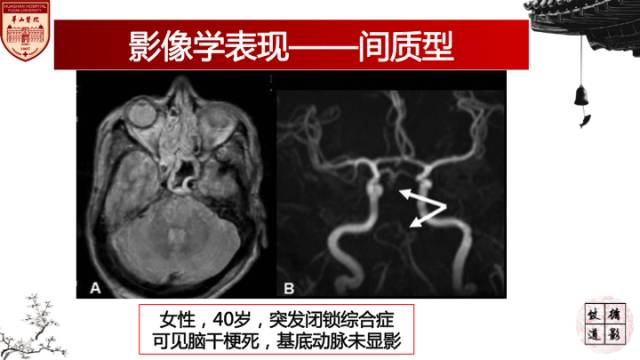 【病例】梅毒树胶样肿1例MR影像诊断与鉴别