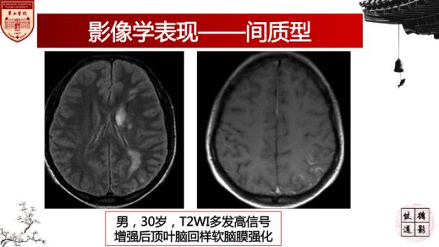 【病例】梅毒树胶样肿1例MR影像诊断与鉴别