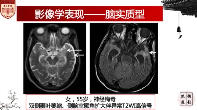 【病例】梅毒树胶样肿1例MR影像诊断与鉴别