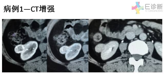 【病例】肾脏肿瘤4例影像诊断与鉴别