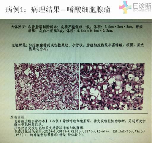 【病例】肾脏肿瘤4例影像诊断与鉴别