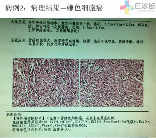 【病例】肾脏肿瘤4例影像诊断与鉴别